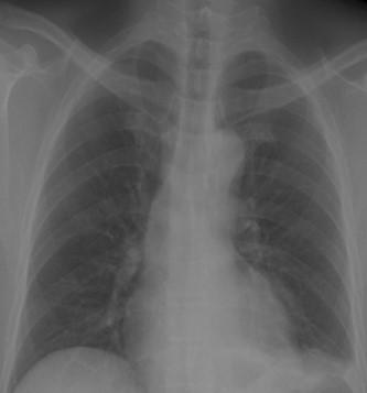 Savoir diagnostiquer un épanchement pleural liquidien chez l'enfant et l'adulte Figure 7a