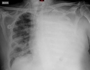 Savoir diagnostiquer un épanchement pleural liquidien chez l'enfant et l'adulte Figure 9