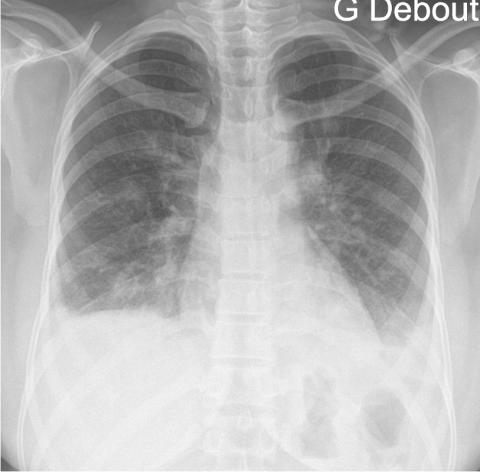 Toux depuis 3 semaines chez une femme de 32 ans