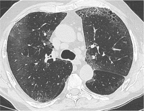 cas février 2026 dyspnée chez une femme de 52 ans