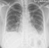Toux depuis 3 semaines chez une femme de 32 ans